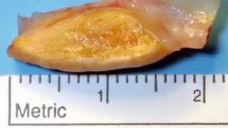 Diseases of the arterial system - Atherosclerosis
