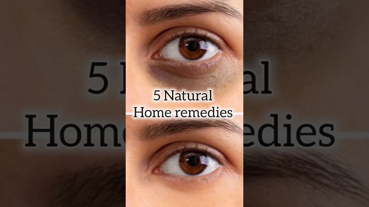 ✨Dark circles under eyes home remedy ✨  natural remedies
