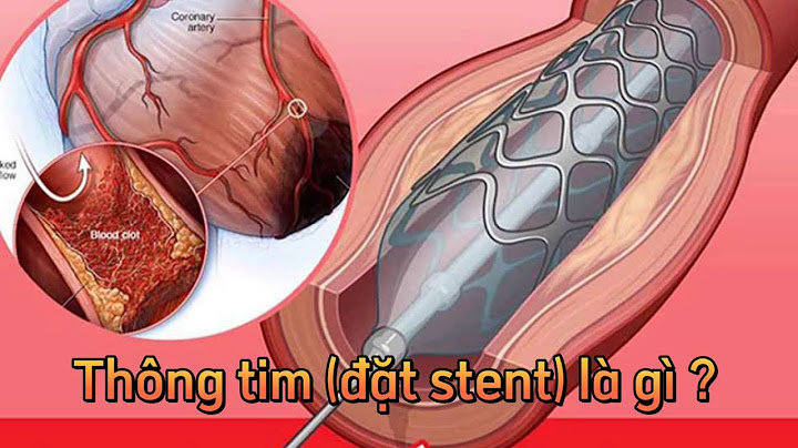 Can thiêph đặt stent mạch vành như thế nào