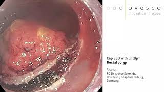 Cap Esd With Liftup Endoscopic Lifting Gel Solution A Large Rectal Polyp
