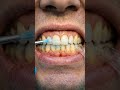 Yellow Teeth to Pearl White 😱 Heavy Stains & Discoloration Removed!