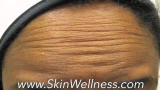 Botox Services at Skin Wellness Center of Alabama