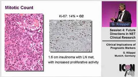 ICON Meeting 2011: Clinical Implications of Prognostic Markers - Dr.Kloppel