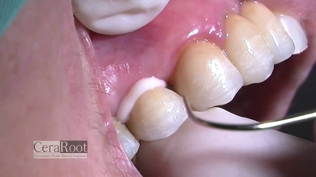 dental implants treatment without metal YouTube
