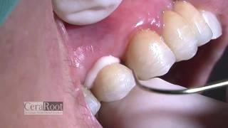 Dental Implants Treatment Without Metal