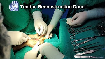 Finger 🖕Flexor Tendon Injury Treatment & Recovery || Complex Hand 🖐️ Injury || Tendon Repair