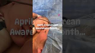 #CesareanAwarenessMonth #BirthTraumaStories #PerinatalTrauma