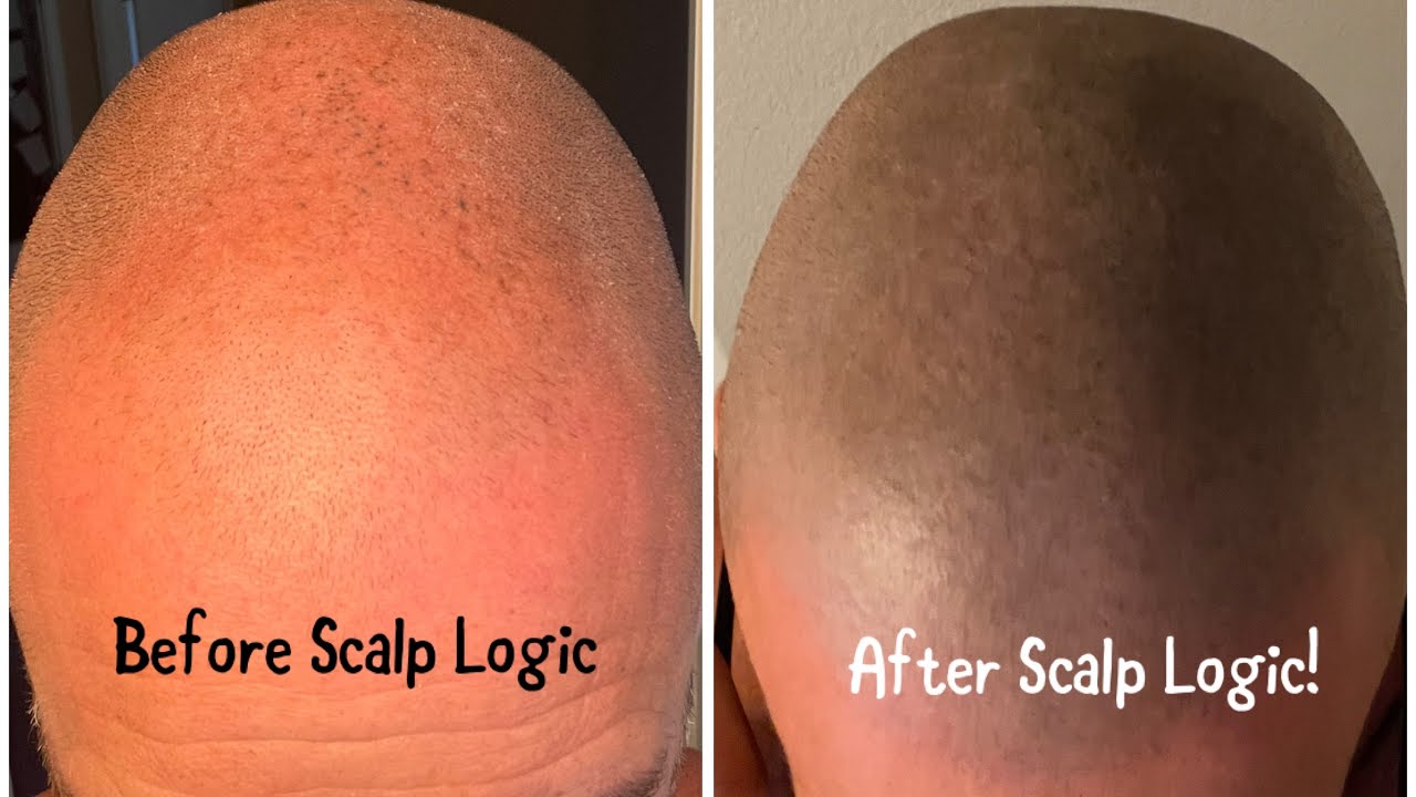 Scalp Logic Testimonial 4 Weeks Post Subtle Scalp MicroPigmentation
