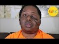 The YouTuber with Tumors on His Face (Living with Neurofibromatosis)