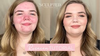 ROSACEA TUTORIAL | how to conceal rosacea
