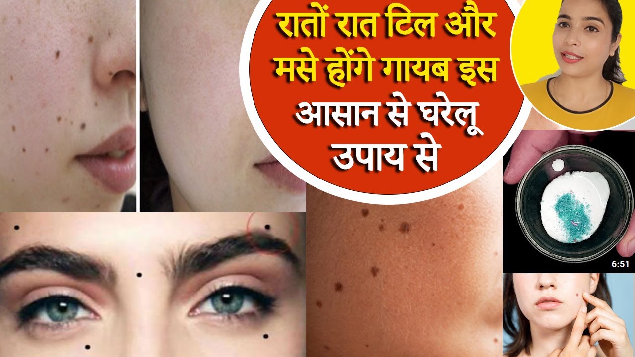 10-how-to-remove-moles-from-face