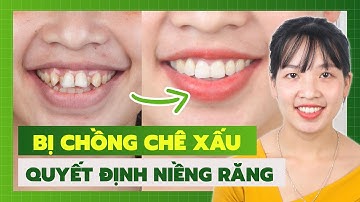 THÁO MẮC CÀI SAU NIỀNG RĂNG KHẤP KHỂNH