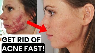 HOW TO GET RID OF ACNE, PIMPLES, HORMONAL, CYSTIC ACNE, BLACKHEADS, WHITEHEADS