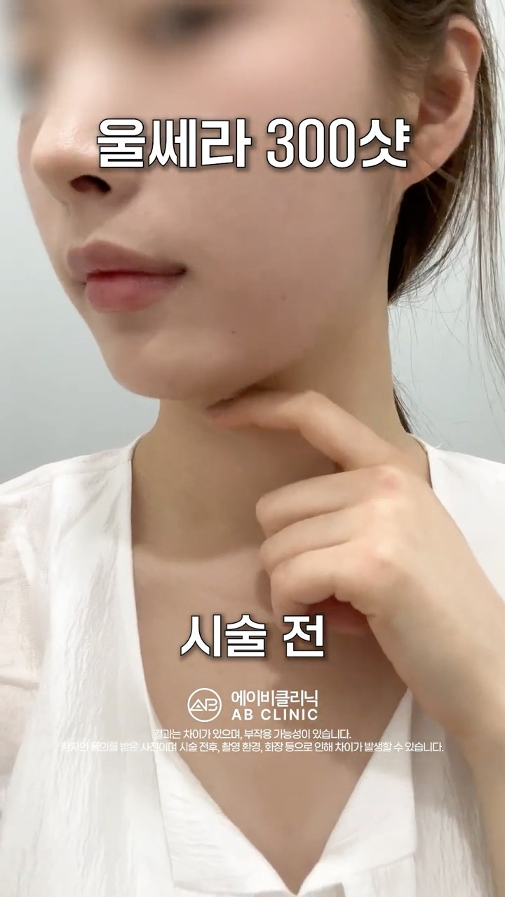 날씬한 사람이 울쎄라 받는다면?