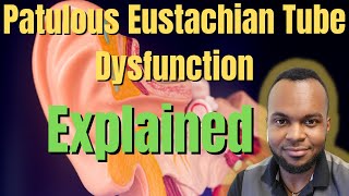 Patulous Eustachian Tube Explained- 3 Things To Be Aware Of