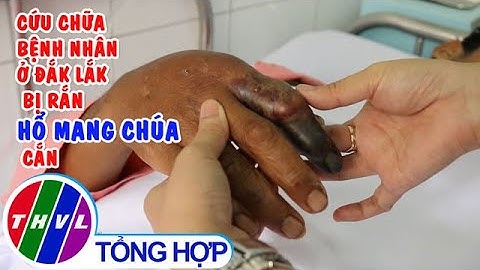 Cứu chữa bệnh nhân ở Đắk Lắk bị rắn hổ mang chúa cắn