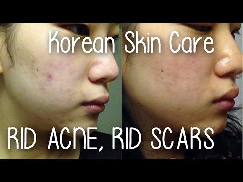 KOREAN SKIN CARE: Ridding Cystic Acne & Dark Acne Scars - ROUTINE & REVIEWS