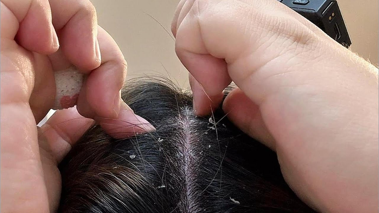 Scalp Massage ASMR: Short Nails, Fine-Tooth Comb & Wood Stick Scratching Scalp Sleep Aid