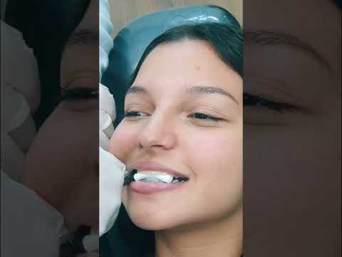 خلعت تقويم الاسنان بعد 4 سنين