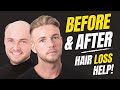 How to Apply (Attach) a Non-Surgical Hair Replacement System for Men with The Harris Brothers