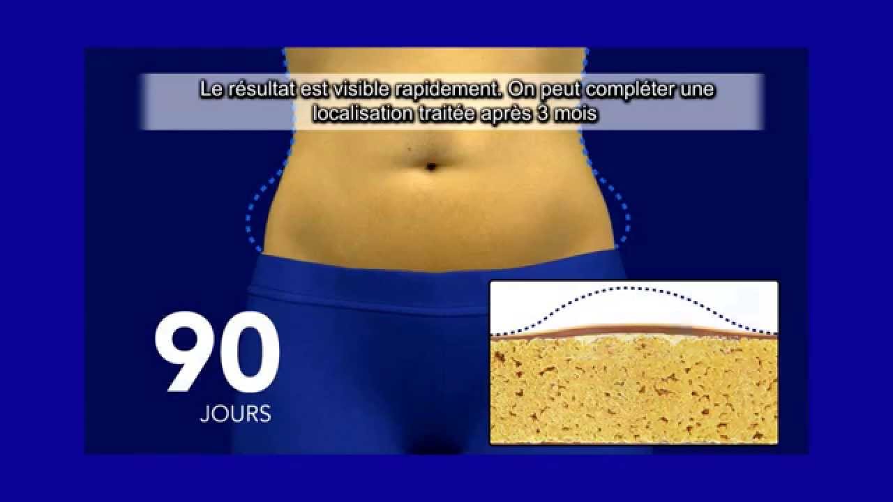 La Cryolipolyse par Coolsculpting a Paris - Centre Marceau
