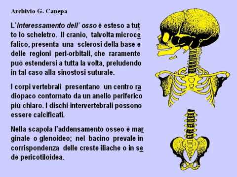 Video: Cos'è la nefrocalcinosi midollare?