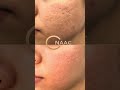 El tratamiento de las cicatrices derivadas del acné facial