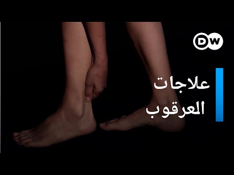 علاجات مناسبة للعرقوب صحتك بين يديك