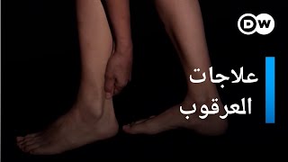 علاجات مناسبة للعرقوب | صحتك بين يديك