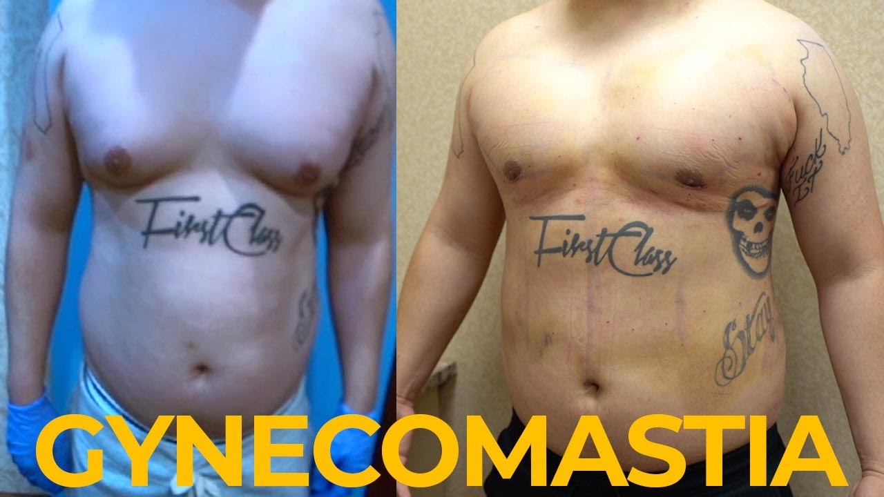 Gynecomastia shirt before after