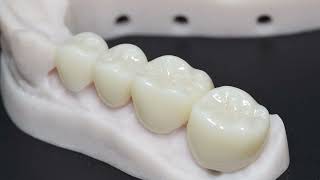 Types of Dental Crown Material 