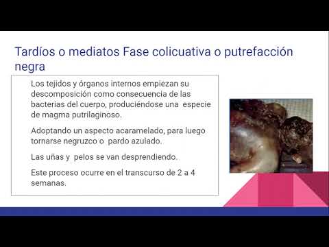 Vídeo: Muerte Súbita Intrauterina Inexplicada: ¿hora De Adoptar Pautas De Investigación Uniformes Postmortem?