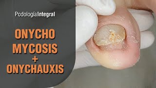 Onychomycosis + Onychauxis #podology #asmr