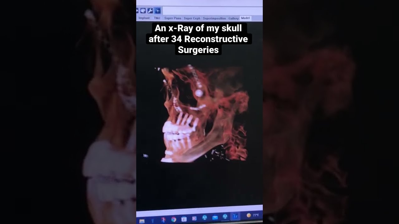 My skull after 34 reconstructive surgeries