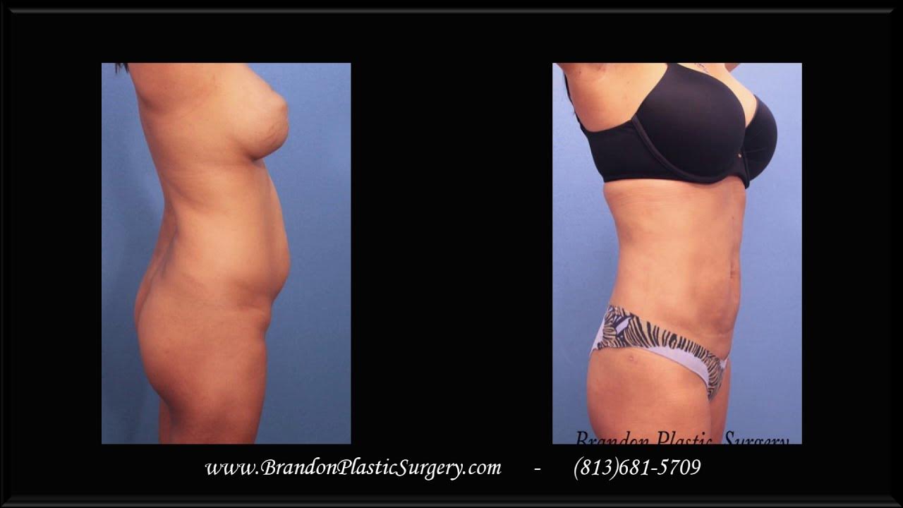 Liposuction of the Muffin Top Waistline Deformity - Explore Plastic Surgery