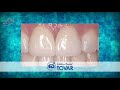 Clínica Dental Tovar - Usos del Zirconio en la Odontología