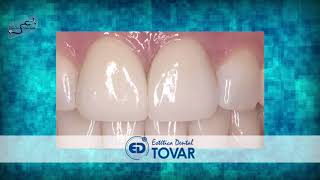 Clínica Dental Tovar - Usos del Zirconio en la Odontología