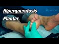 &quot;HIPERQUERATOSIS PLANTAR&quot; PODOLOGO RAFAEL GILES C.