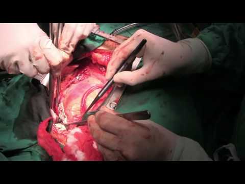 Cardiac Surgery at the Military Hospital, Serbia