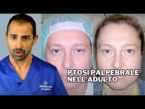 Video: Ptosi: Trattamento, Cause, Intervento Chirurgico