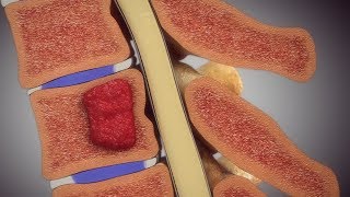 Spine Injury Animation with Hemangioma screenshot 5