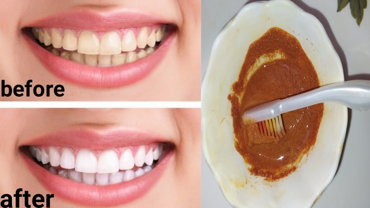 Teeth Whitening AT Home In 3 MinutesHow to Whiten Your Yellow Teeth