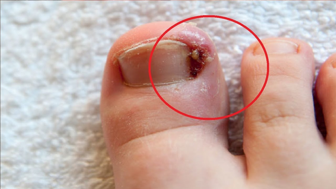 how to treat ingrown toenail with dental floss fast YouTube