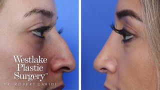 Rhinoplasty Surgery Experience - A Nose Job Before And After Journey - Rhinoplasty Recovery