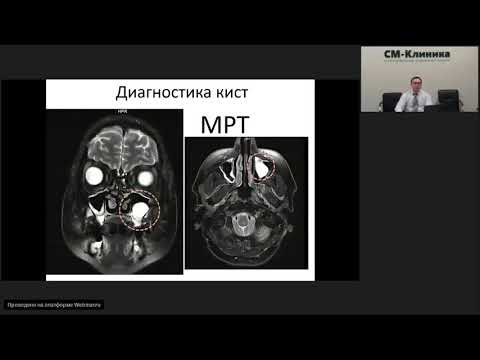 Запись вебинара «Кисты верхнечелюстных пазух» - Фуки Е.М. (19.09.2018)