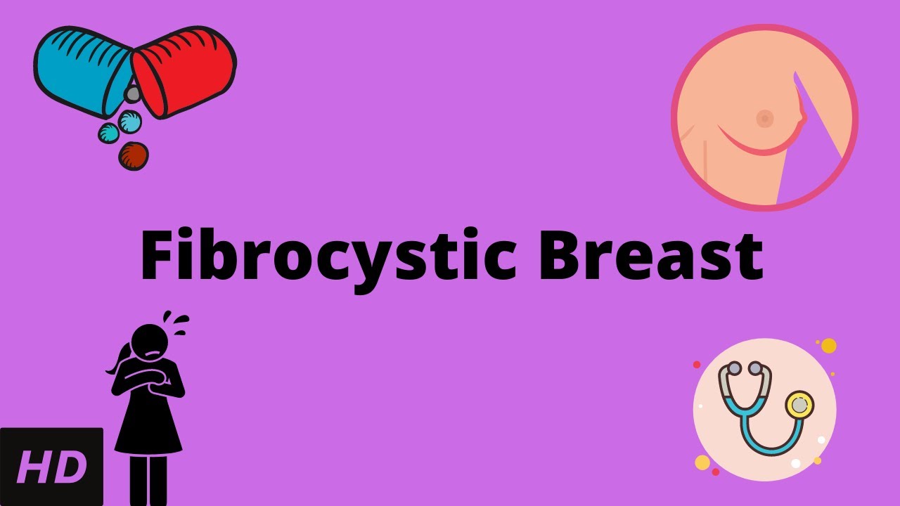 Fibrocystic Breast Causes Signs And Symptoms Diagnosis And Treatment