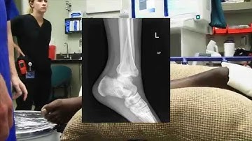 Ankle Fracture Dislocation Reduction