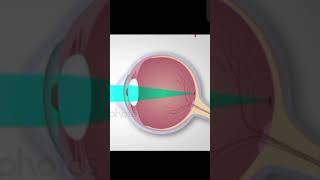 Myopia Hypermetropia  in 40 seconds and its solutions ??eyesight eyecare vision upsc ias love