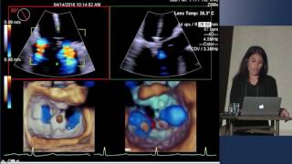 Echo Assessment for MitraClip