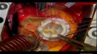 Neue Herzklappe Durchs Schlusselloch Minimalinvasiv Youtube